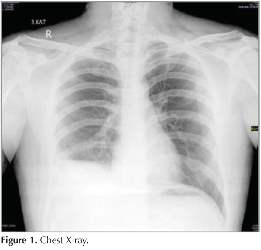 Pulmoner tromboemboli olgusu